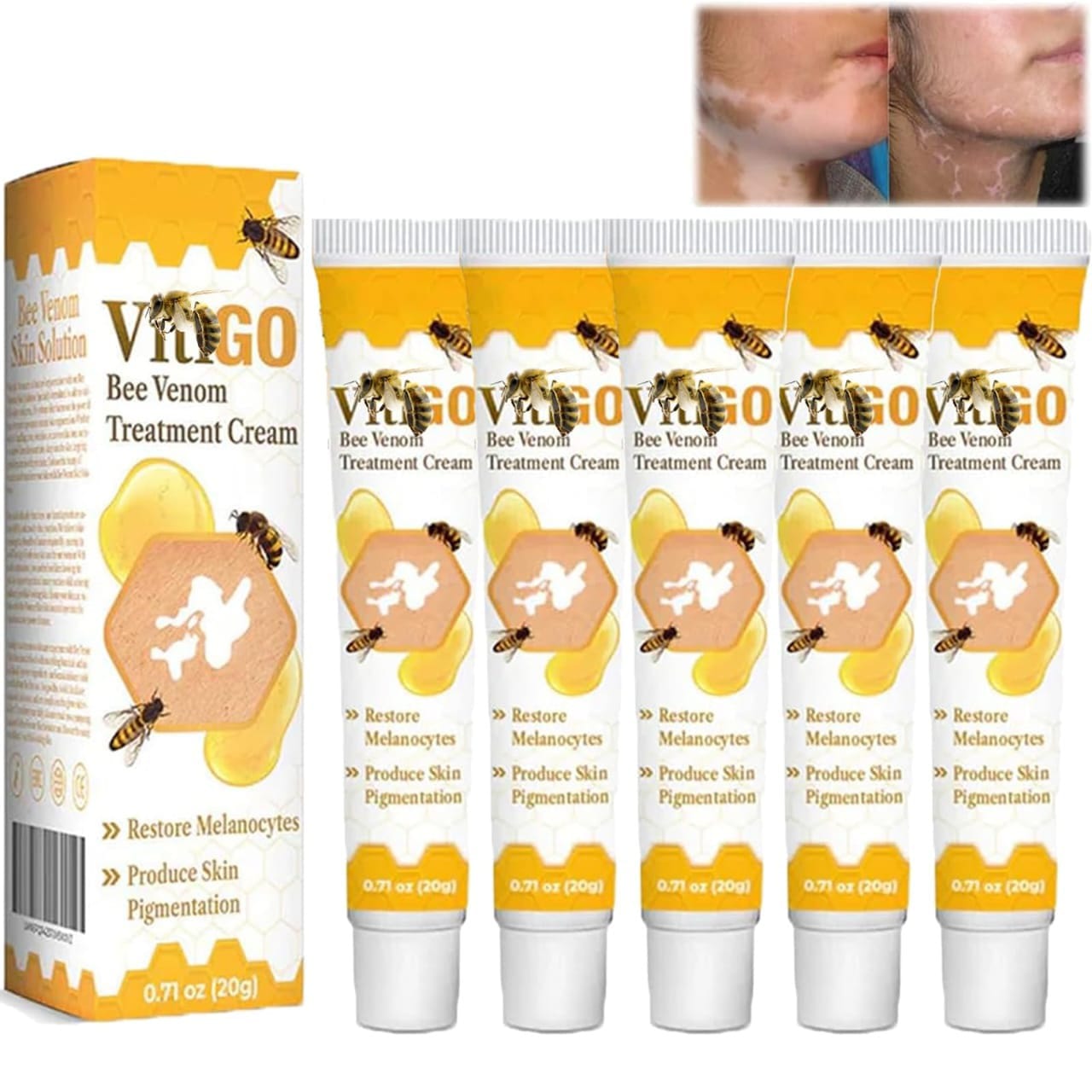 fivfivgo™ vitigo bee venom correcting cream (20g) – advanced melanocyte support for skin pigmentation recovery and even skin tone fivfivgo™ vitigo bee venom correcting cream (20g) – advanced melanocyte support for skin pigmentation recovery and even skin tone